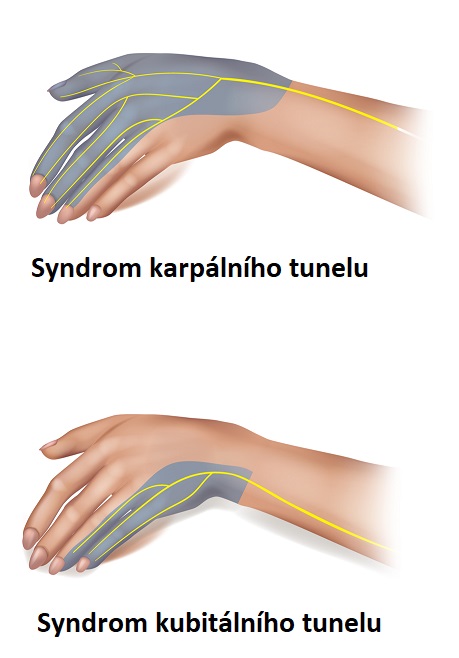 Rozdíl mezi syndromem kubitálního tunelu a syndromem karpálního tunelu
