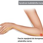 Syndrom kubitálního tunelu – příznaky, příčiny a léčba