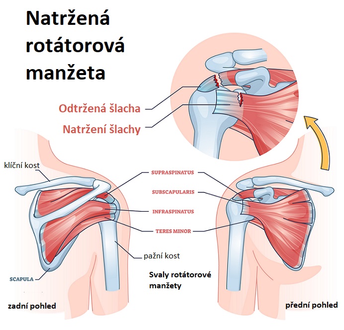 Natržená rotátorová manžeta - ilustrace