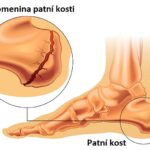 Zlomenina patní kosti – příznaky, příčiny a léčba