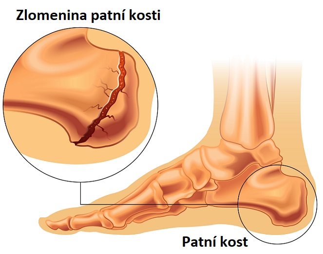 Zlomenina patní kosti - ilustrace