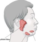Sialoadenitida (zánět slinné žlázy) – příznaky, příčiny a léčba