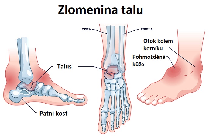 Zlomenina talu - ilustrace