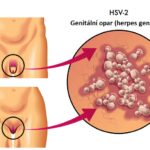 Genitální herpes (HSV-2, genitální opar) – příznaky, příčiny a léčba