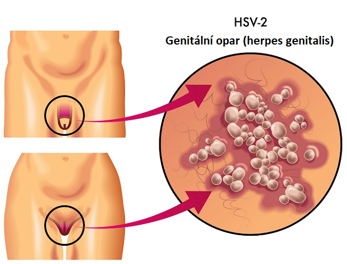 Genitální opar (herpes genitalis) - ilustrace