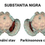 Idiopatická Parkinsonova nemoc – příznaky, příčiny a léčba