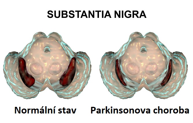 Substantia nigra u této choroby