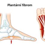 Plantární fibrom: jak na něj? Příznaky, příčiny a léčba