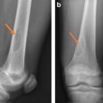 Neosifikující fibrom: příznaky, příčiny a léčba