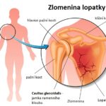 Zlomenina lopatky: příznaky + jak se dá léčit