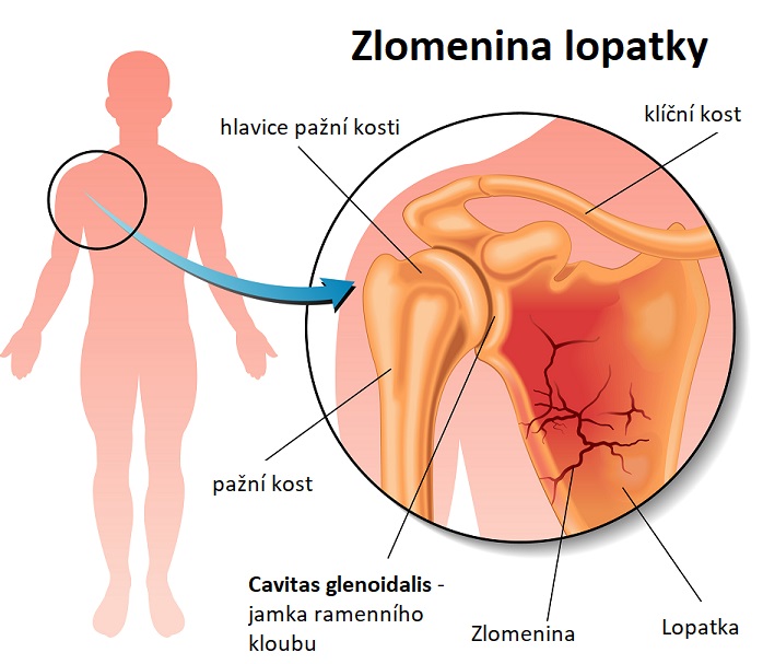 Zlomenina lopatky - ilustrace