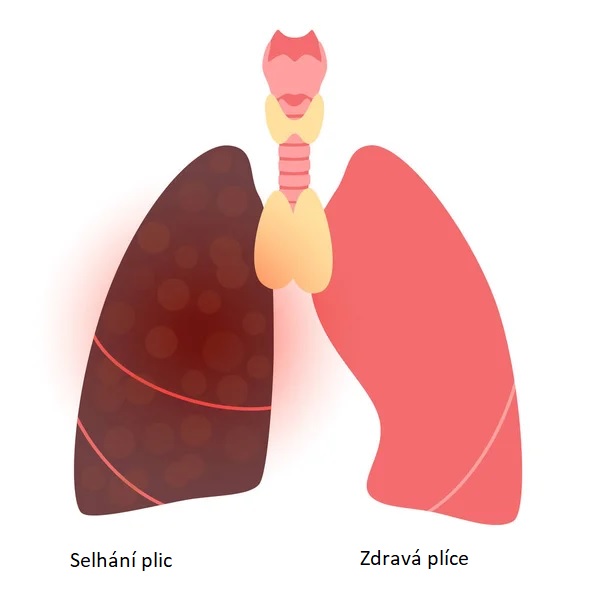 Selhání plic - ilustrace